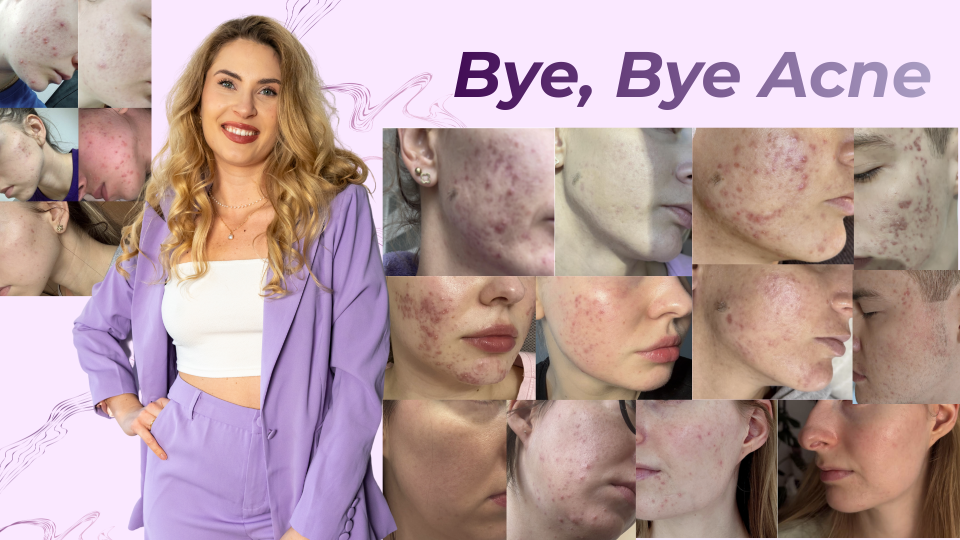 KURS: Bye, bye Acne